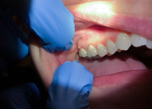 Best Emergency Wisdom Tooth Extraction in Davidson, NC