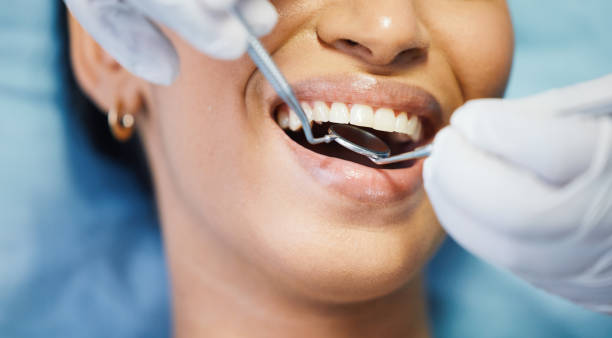 Best Emergency Wisdom Tooth Extraction in Davidson, NC